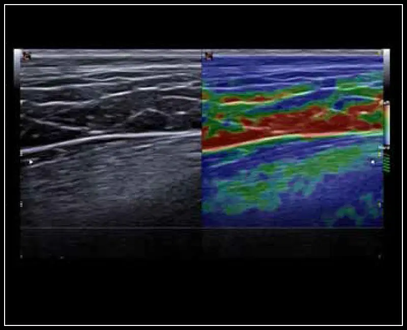 Klinik Görüntü - MyLab ™ X7VET - Quadriceps femoris - ElaXto (Köpek)