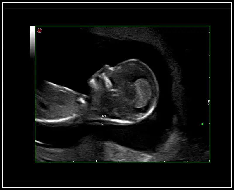 MyLab ™ 9 Platformu - AutoNT ölçümü ile fetus profiline HD Yakınlaştırma