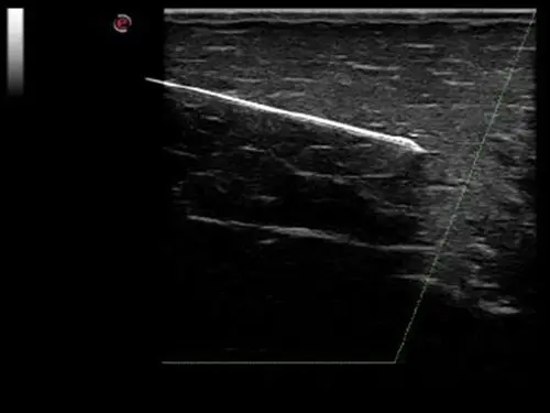 MyLab ™ Alpha - Needle Enhancement