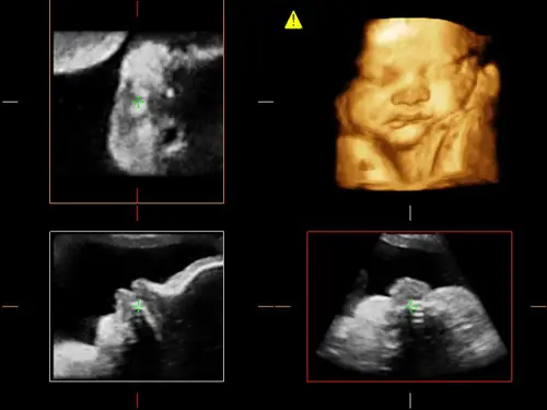 MyLab ™ ClassC - Bebek Yüzü (X4D Görüntüleme) Kadın Doğum