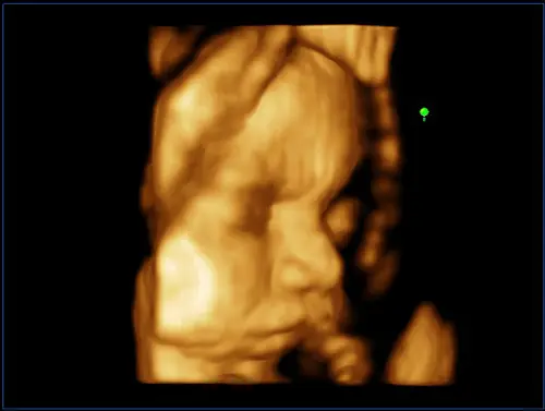 MyLab ™ ClassC - Bebek Yüzü (X4D Görüntüleme) Kadın Doğum