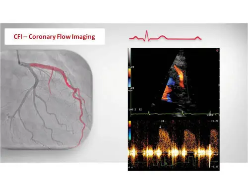 MyLab ™ ClassC - Koroner Akış Görüntüleme (CFI)