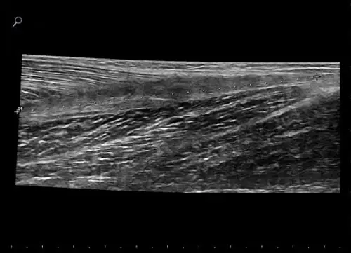 MyLab ™ Gama - Akuil tendonu (VPan Görüntüleme)