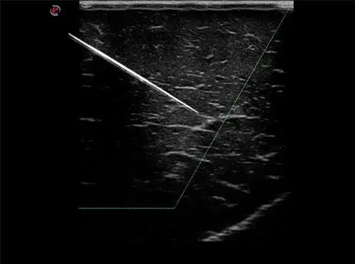 MyLab ™ Seven - Needle Enhancement