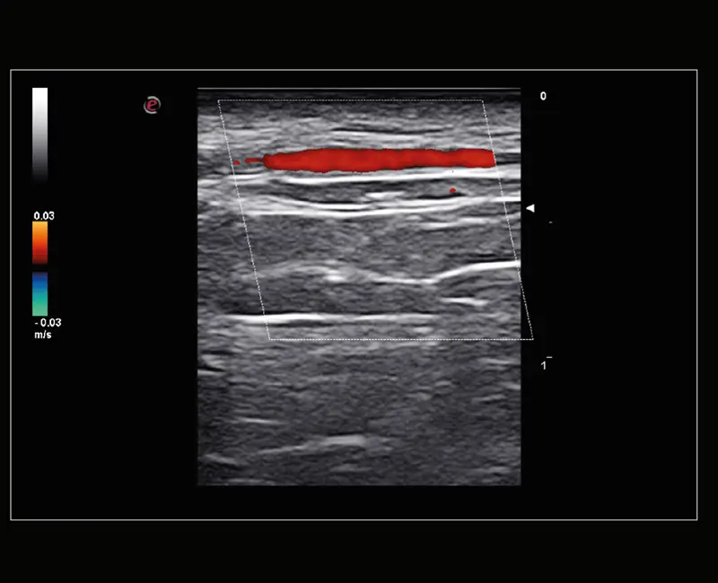 MyLab ™ Sigma Elite - Klinik Görüntü - Çok Yüksek Frekanslı prob (22 MHz) ile Temporal Arter keşfi (tüm ülkelerde mevcut değildir)