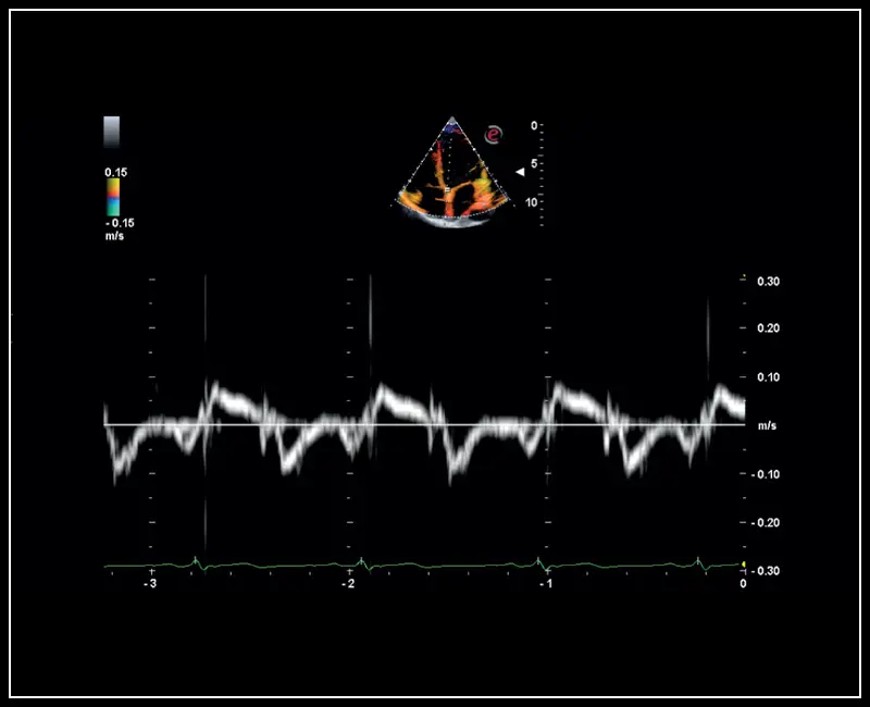 MyLab ™ Sigma - Klinik Görüntü: Doku Hızı Haritalama ile mitral kapak arka yaprakçık analizi
