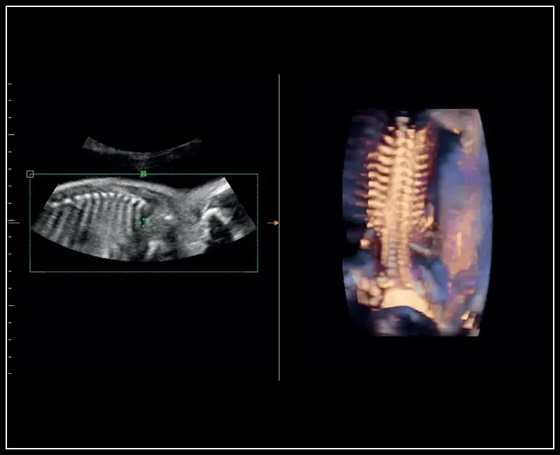 MyLab ™ Sigma - Klinik Görüntü: Fetal omurganın yarı şeffaf görüntüsü