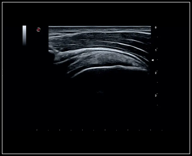 MyLab ™ Sigma - Klinik Görüntü: Omuzun MSK görüntülemesi