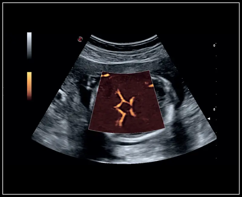 MyLab ™ Sigma - Klinik Görüntü: Power Doppler ile Fetal Willis halkası