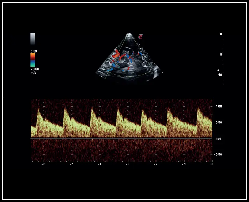 MyLab ™ Sigma - Klinik Görüntü: PW Doppler modu ile orta serebral arter incelemesi
