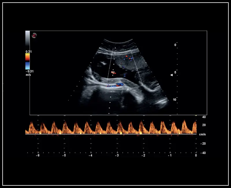 MyLab ™ Sigma - Klinik Görüntü: Umbelikal kordon PW Doppler modu