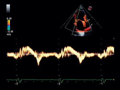 MyLab ™ Six - Kalp Dokusu Doppler (TVM Görüntüleme)