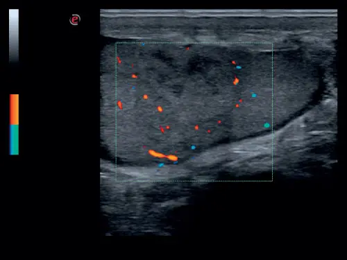 MyLab ™ Six - Testis (B + CFM Görüntüleme)