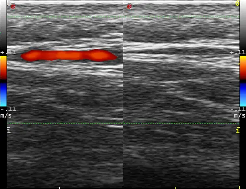 MyLab ™ Twice - Temporal arterit - çift görünümlü CFM