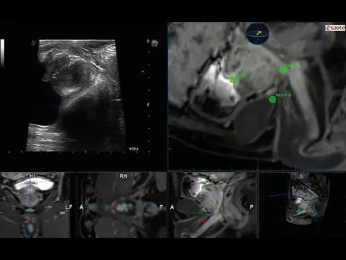MyLab ™ Twice - TRUS-MRI Navigasyonu