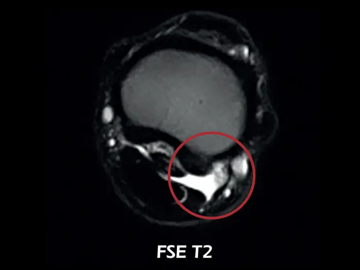 O-scan equine: Fetlock Artropati